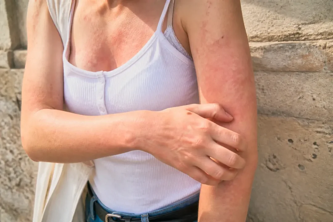 Femme souffrant d'irritation cutanée sur le bras pour reconnaître une allergie aux aubergines